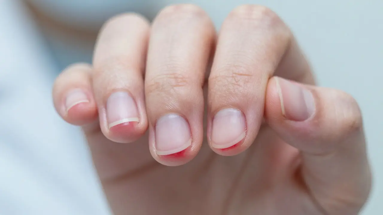 Proč přestat kousat nehty? Rizika, dopady na zdraví a jak se zbavit tohoto zlozvyku