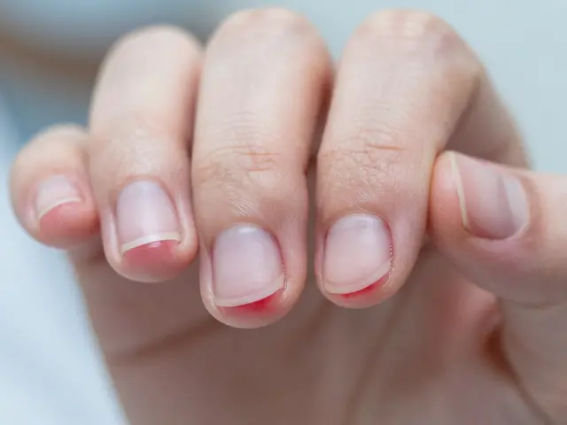 Proč přestat kousat nehty? Rizika, dopady na zdraví a jak se zbavit tohoto zlozvyku