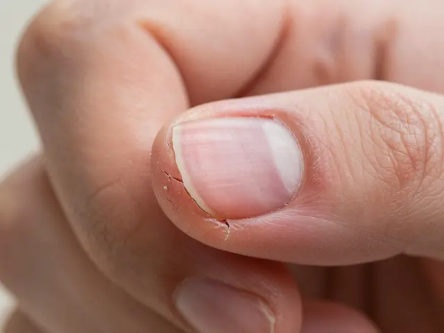 Záděry na nehtech: Chybí vám vitamín B, železo nebo jen vlhkost?